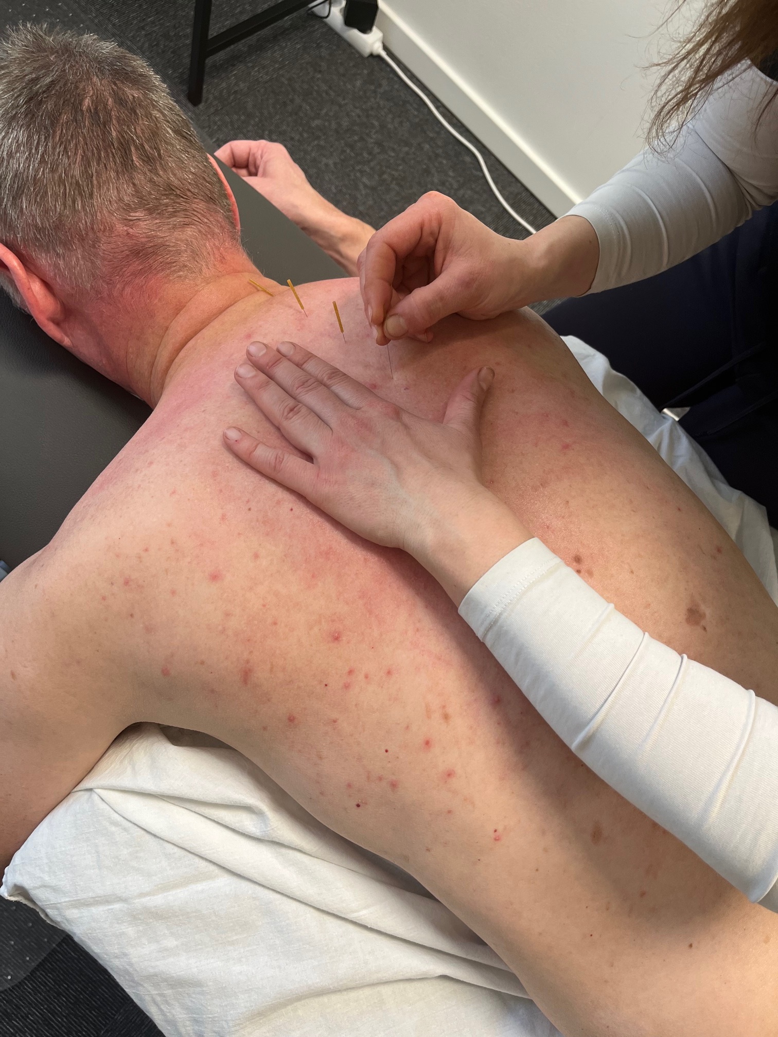 Formålet med akupunktur er at lindre smerter, genvinde fysisk funktion og bedre nattesøvnen